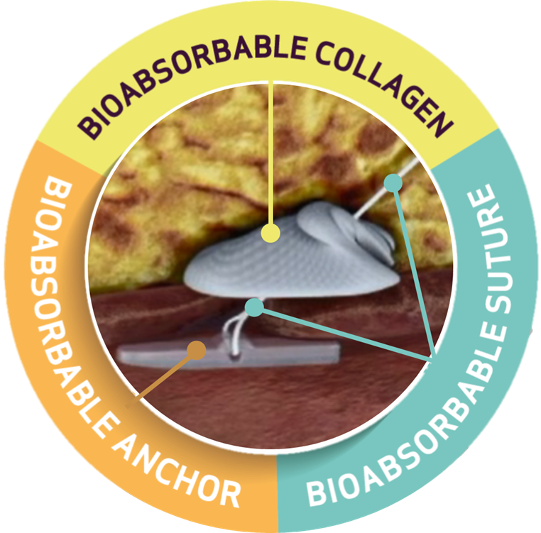 AngioSeal™ VIP Vascular Closure Device